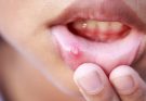 Crohn’s Disease Mouth Sores: Causes, Symptoms, and Treatments