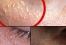Tiny White Bumps on Your Face? Here’s What They Are—And How to Treat Milia Naturally and Safely at Home