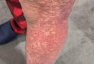 These are the consequences of sleeping with many…