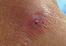 He Thought He Had Acne, But It Was Something Completely Different..Check 1st comment