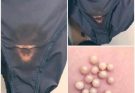 BE CAREFUL, if you notice this in your underwear, it means you have Ca…see more