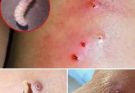 “Larvae Found in Young Woman After Mysterious Illness Shocks Doctors — Medical Team Discovers Rare Parasitic Infestation That Went Undetected for Weeks, Prompting Urgent Warnings About Travel, Hygiene, and Early Symptoms Everyone Should Know. What Happened to Her Could Happen to Anyone — See the Shocking Details and How She’s Recovering Now.”