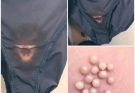 BE CAREFUL: If You Notice This in Your Underwear, It Could Be a Sign of a Serious Health Condition, Including Cancer, Prompting Immediate Attention From Medical Professionals, Early Detection, and Proper Screening, While Raising Awareness About Symptoms That Many People Might Overlook, and Emphasizing the Importance of Listening to Your Body and Acting Quickly to Protect Your Health