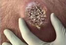 Their Acne Is Severe — But What Doctors Discovered Was Far More Alarming Than Just Skin Deep. After Years of Pain, Embarrassment, and Failed Treatments, the Real Cause Was Finally Uncovered, Leading to a Shocking Diagnosis and a Life-Changing Breakthrough That Could Help Thousands Suffering in Silence.